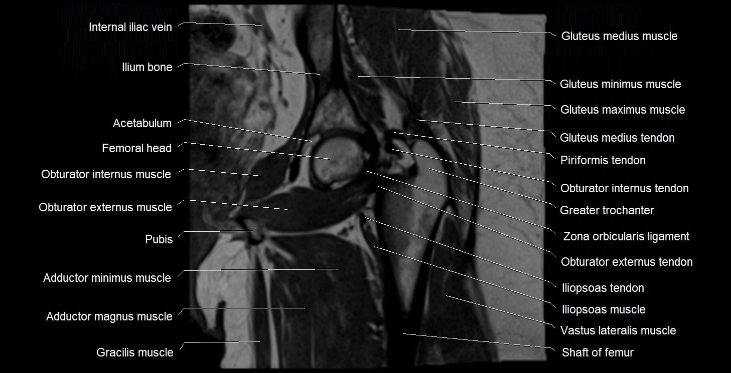 MRI Hip 3T coronal cross sectional anatomy image 37.webp
